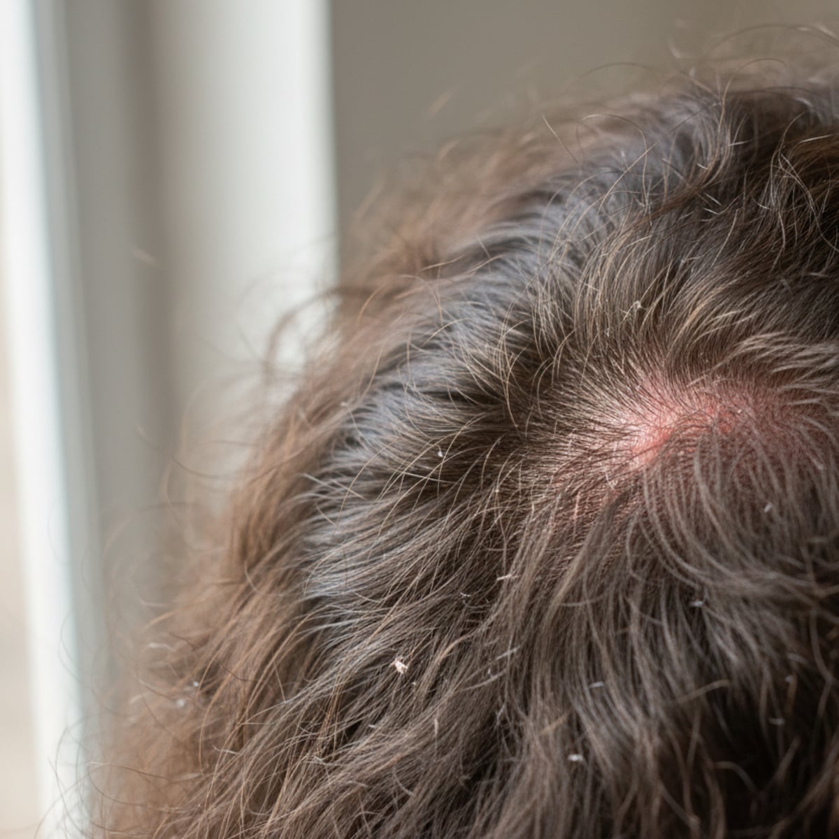 Why Your Scalp Itches After Every Shower