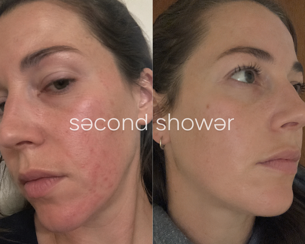 Why Your Skin Flares Up After Showers (and How to Fix It)