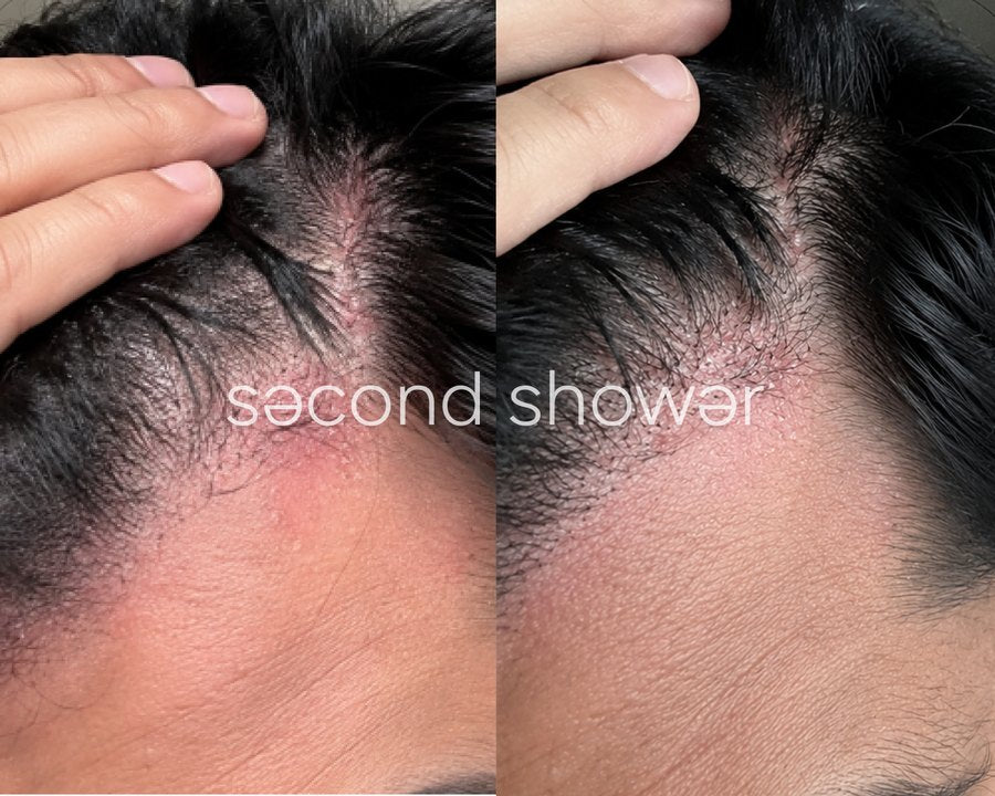 Customer photo: scalp and hairline, before and after