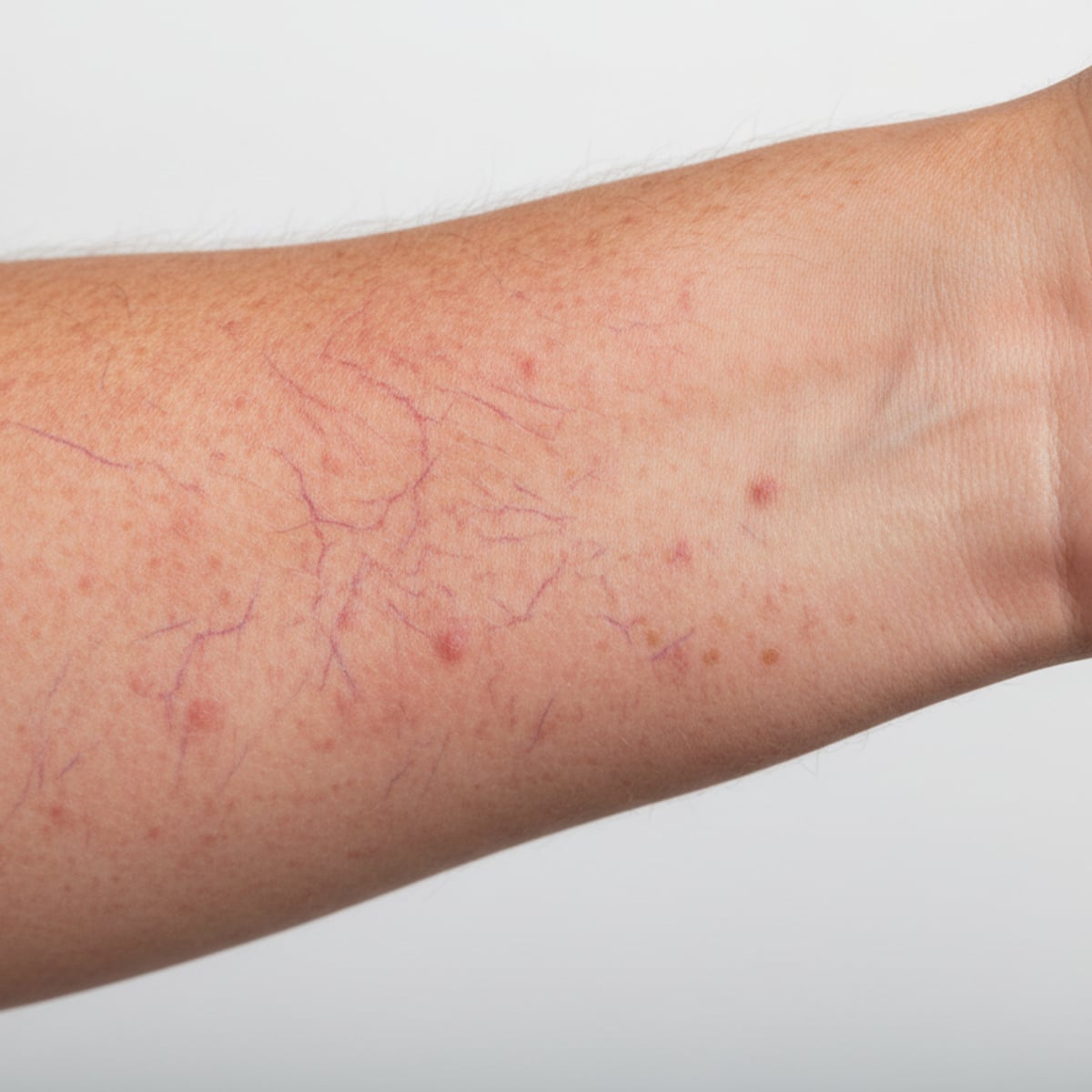 Does Shower Water Make Rosacea Worse? Filters That Help
