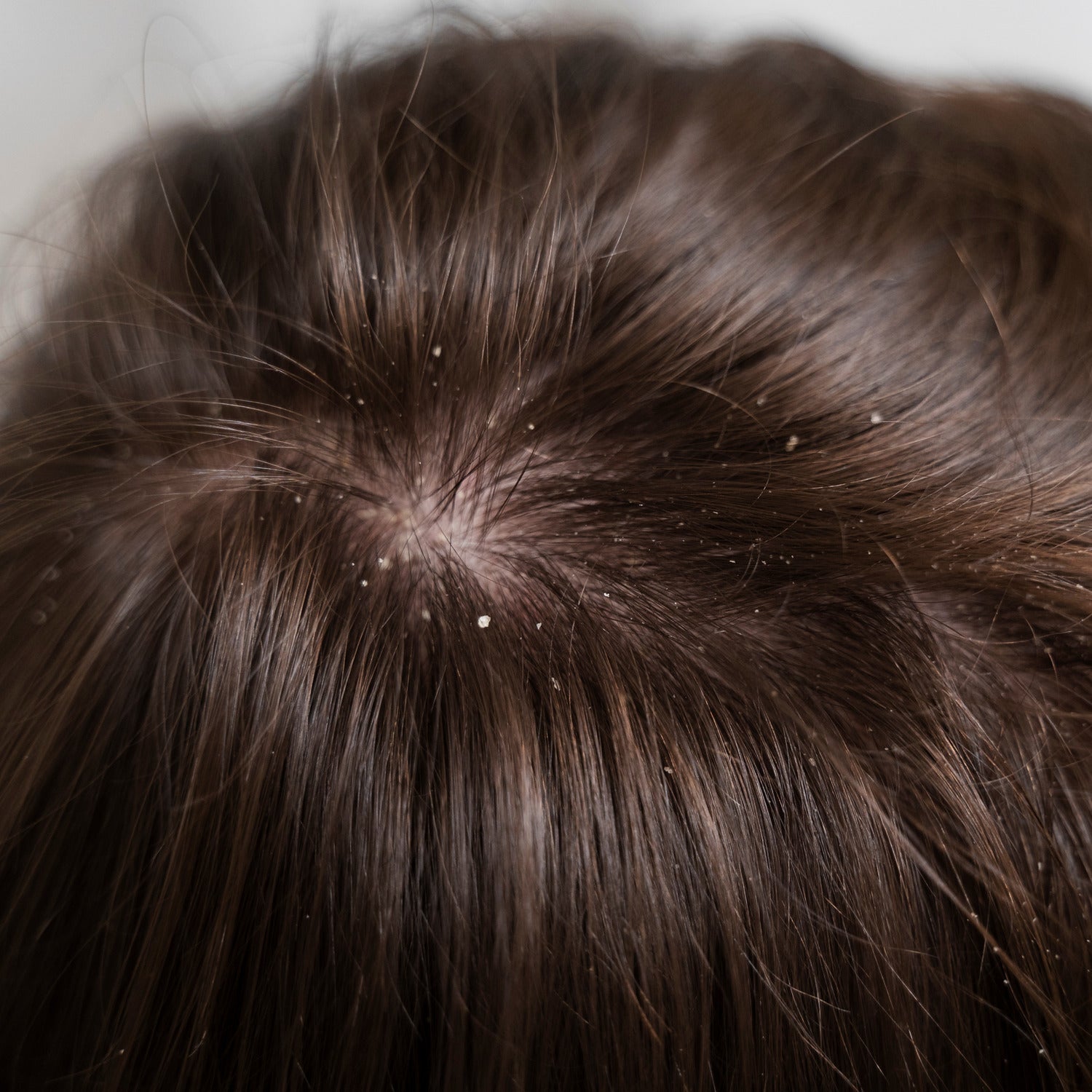 How to Tackle Dandruff with a Shower Filter