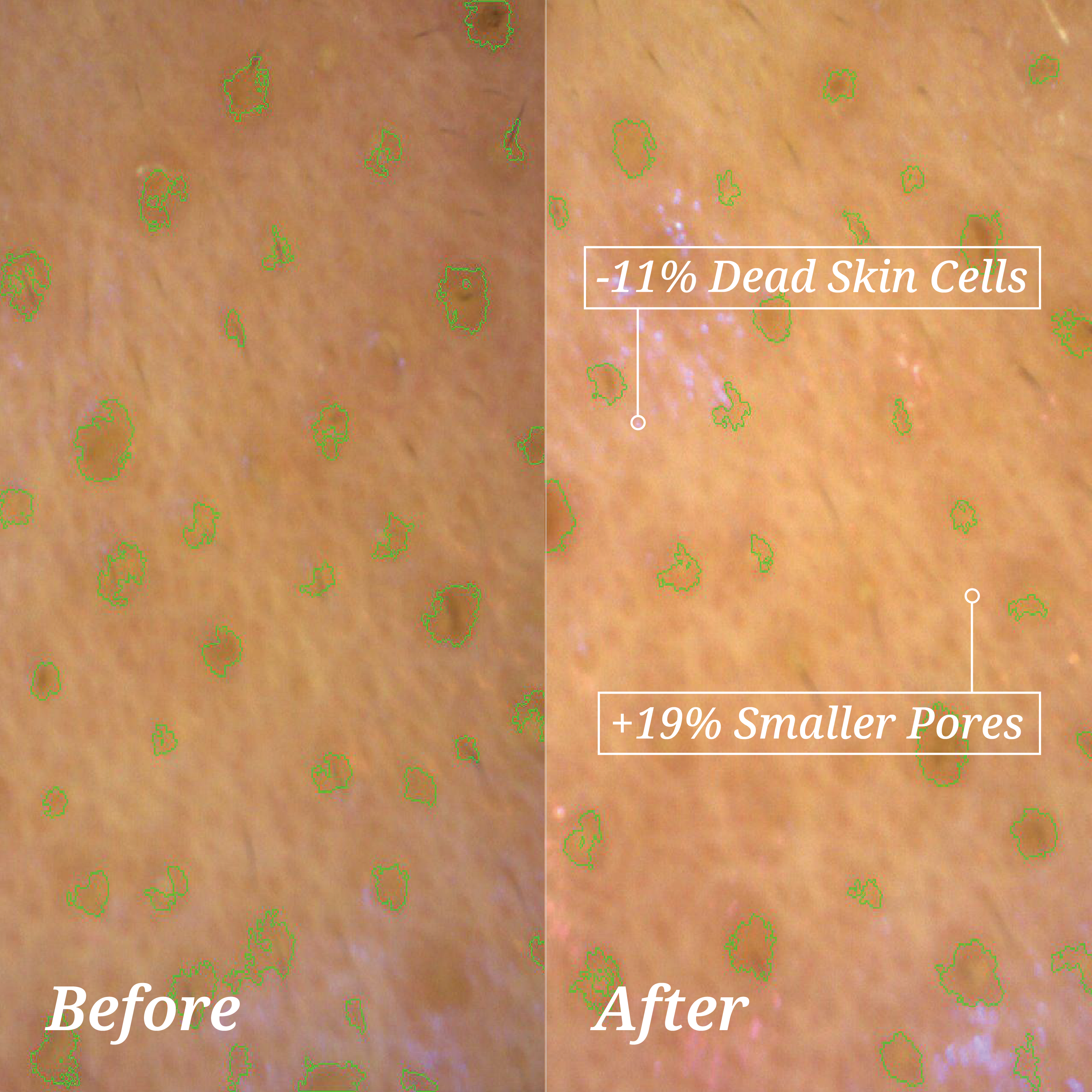 Clinically tested before-and-after image showing reduced dead skin cells and smaller skin pores after 2 weeks using the Second Shower Head.