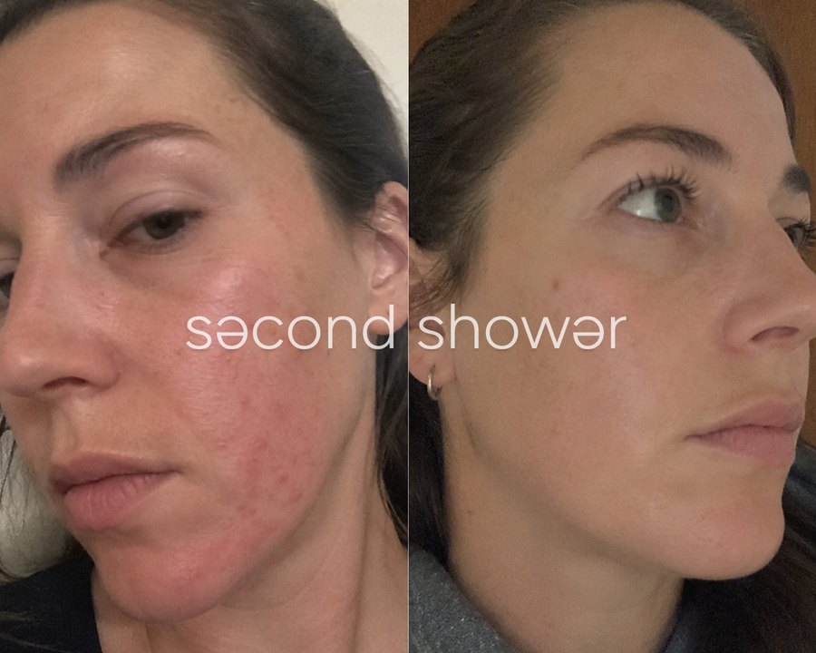Customer photo: visible redness, before and after